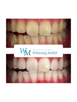 ホワイトニング モア(Whitening MORE)の写真/初回特別価格でお試し可能♪なのに初回からしっかり効果実感で大満足間違いなし♪【歯科医院提携サロン】