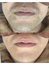 アカラ 読谷店(AKALA)/ヒゲ脱毛継続して２か月が経過