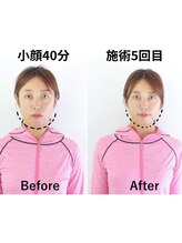 リバイブ 五反田店(REVIVE)/5回でリフトアップ小顔矯正