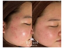 リソルバイスリール(Re:sol by sourire)/Re:sol ハーブピーリング専門店