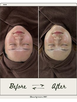 カラット(CARAT)/光フェイシャル×ララピール