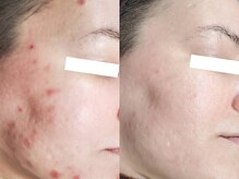 剥離なし・あり、ハーブピーリング！あなたの肌状態に合わせた選び方を解説