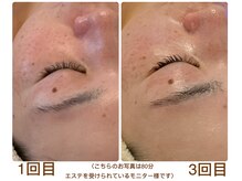 ルル リラクゼーション(RURU Relaxation)/小顔リフト/ツヤ.ハリ/小じわ