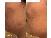 ファームディ(Pharm.D)/ニキビケアケア