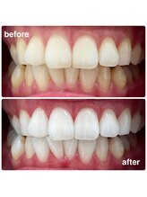 エクシアホワイトニング 日本橋店/ホワイトニング経過写真