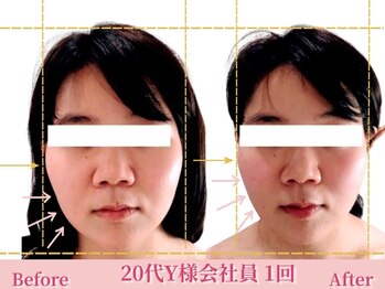 アメリイ 百合ヶ丘 新百合ヶ丘(Amerii)/[20代小顔]１回韓国アイドル小顔