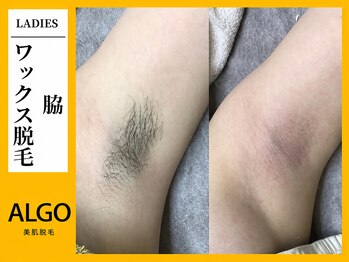 アルゴ 柳川店(ALGO)/脇WAX脱毛