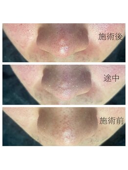 メンズプシュケ(men's PSYCHE)/韓国式3D毛穴洗浄