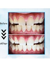 エクシアホワイトニング 塩釜口駅前店/３０代半ば男性の効果事例