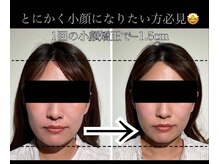 ユウサク(Yusaku)/30代症例【小顔矯正/本町/梅田】