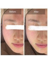 ラビ(RABBI)/10代女性毛穴洗浄コースのお客様