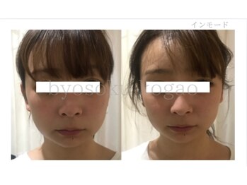 メディカルエステ 新宿南口店/*インモードリフト症例写真*