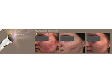 エステサロン ジジ 新宿(JIJI)/ハーブピーリング、プラズマ新宿