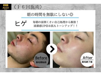 アルゴ 南茨木駅前店(ALGO)/【メンズ髭脱毛】
