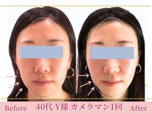 アメリイ 百合ヶ丘 新百合ヶ丘(Amerii)/[40代小顔矯正]韓国整顔フェイス