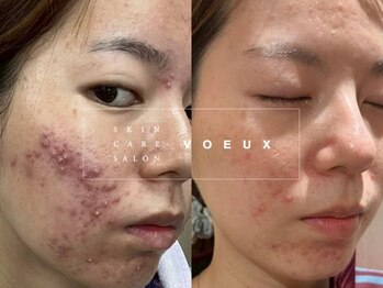 ボウ 静岡本店(VOEUX)の写真/何をしても変わらなかった繰り返すニキビに◎専門歴13年・23,000人の実績