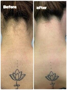 エリーザベル(Elisa Bell)/うなじ&背面ワックス