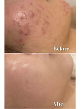 メナードフェイシャルサロン 片町店/ニキビ肌荒れ根本ケア