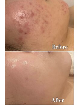 メナードフェイシャルサロン 片町店/ニキビ肌荒れ根本ケア