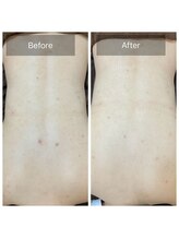 アーユルヴェーダアンドアロマエステ アユス(AYUS)/ハーブピーリング背中