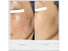 イベリス(Iberis)/ハーブピーリング/シミケア