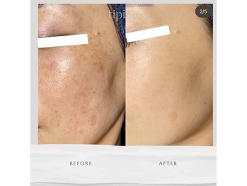 イベリス(Iberis)/ハーブピーリング/シミケア