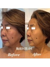 ティアラ(TIARA)/【小顔、たるみ】テラボーラー