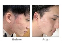 マリーローランメンズグレース(Marryrolan MensGrace)/リベルハーブピーリング症例