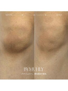 アーヒル(A”-HILU)/バイミュリー メラニンケア 膝