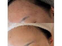 肌年齢とニキビ・肌トラブル根本改善