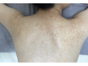 リベル 名古屋(Lebelle:)/ハーブピーリング専門 名古屋