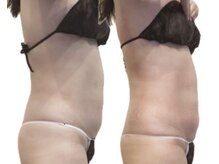 ルナ(Luna)/上半身痩身