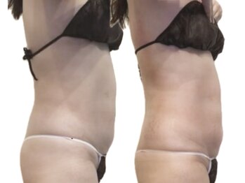 ルナ(Luna)/上半身痩身