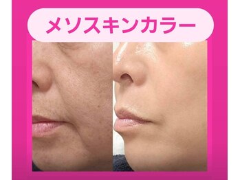 アン 銀座(ann)の写真/【銀座、東銀座】話題のレッドショットで即効ハリ艶肌へ