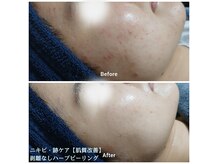 ベルクラージュ(Belle Courage)の雰囲気（REVI 剥離なし・ダウンタイムなし・100%国産ハーブピーリング★）
