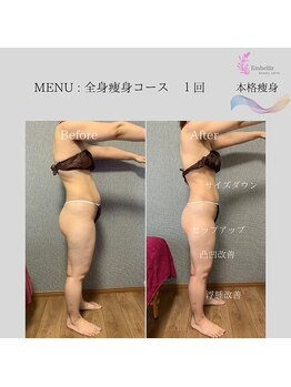 アンベリール(Embellir)/全身の凸凹脂肪撃退！