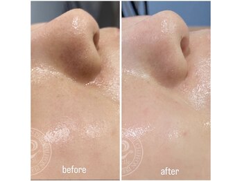 マリーローラン グレース/リベルシフォンピーリング