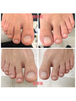 スペシャルフットケア