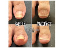 キラキラフット神領 ありが接骨院の雰囲気（どんな巻き爪でも対応可能！長年の巻き爪の痛みから解放☆）