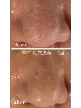 マリエンドリー/毛穴洗浄50代
