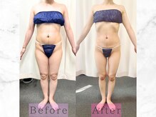 パラディ(PARADIS)/ハイパーナイフ/シェイプ/コルギ