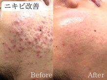 サロンドペオニー 川内店(salon de peony)の雰囲気（20代女性ニキビ改善[毛穴/小顔/シミ/フェイシャル］）