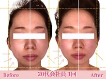 アメリイ 百合ヶ丘 新百合ヶ丘(Amerii)/[20代小顔矯正]挙式撮影歪み改善