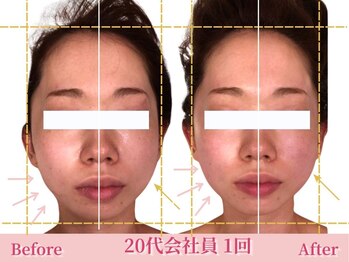 アメリイ 百合ヶ丘 新百合ヶ丘(Amerii)/[20代小顔矯正]挙式撮影歪み改善