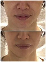 アキ/初回お試しbefore＆after