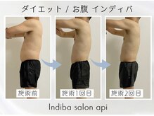 アピ(api)/症例写真【痩身インディバ】