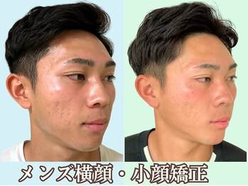 ナチュラルパーフェクトフェイス 新宿/メンズ横顔/新宿駅小顔矯正造顔