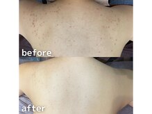 サージュクロレ 松戸店(sage colorer)/クリスタルハーブピーリング(体)