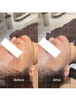 ハリオン 中目黒(HARI-ON)/初回 BeforeAfter