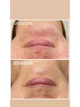 リレフー(Relafy)/にきびでお悩みの方にも是非